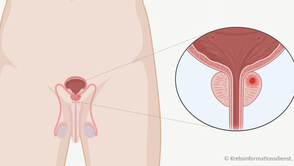 Grafische Darstellung der Lage der Geschlechtsorgane, Harnblase, Harnröhre. In der Prostata befindet sich ein Tumor (rot).