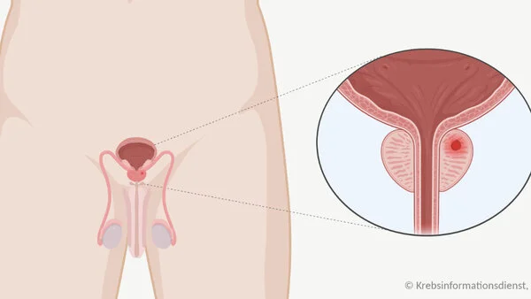 Grafische Darstellung der Lage der Geschlechtsorgane, Harnblase, Harnröhre. In der Prostata befindet sich ein Tumor (rot).