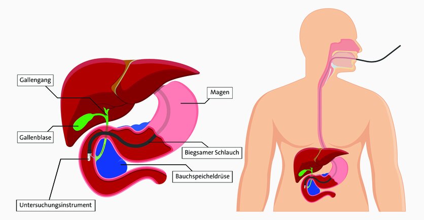 Endoskopisch retrograde Cholangiopankreatikographie , © rumruay, Shutterstock (Grafik redaktionell bearbeitet) Grafische Darstellung einer endoskopisch retrograden Cholangiopankreatikographie (ERCP): Dabei bekommt der Patient oder die Patientin vom Arzt einen dünnen, biegsamen Schlauch (Endoskop) über die Speiseröhre bis zur gemeinsamen Mündung von Gallen- und Bauchspeicheldrüsengängen im Zwölffingerdarm geschoben.