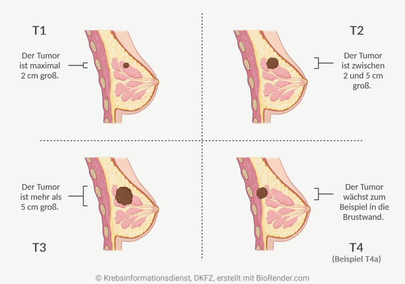 T-Status bei Brustkrebs, © Krebsinformationsdienst, DKFZ; erstellt mit BioRender.com Das T der TNM-Klassifikation gibt an, wie groß der Ursprungstumor ist (Hinweis: Die Zentimeterangaben beziehen sich auf den Durchmesser des jeweiligen Tumors).