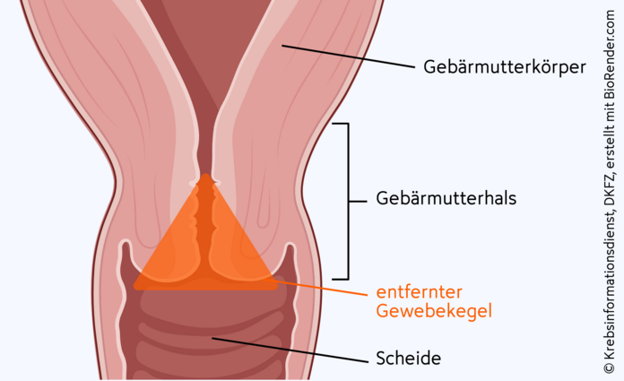 Grafische Darstellung einer Konisation, bei der die Ärzte einen Gewebekegel aus dem Gebärmutterhals ausschneiden.