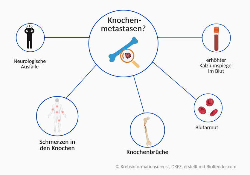 Symptome bei Knochenmetastasen, © Krebsinformationsdienst, DKFZ, erstellt mit BioRender.com Symptome bei Knochenmetastasen: Schmerzen in den Knochen, Knochenbrüche, neurologische Ausfälle; auch Blutarmut oder ein erhöhter Kalziumspiegel können auf Knochenmetastasen hinweisen.