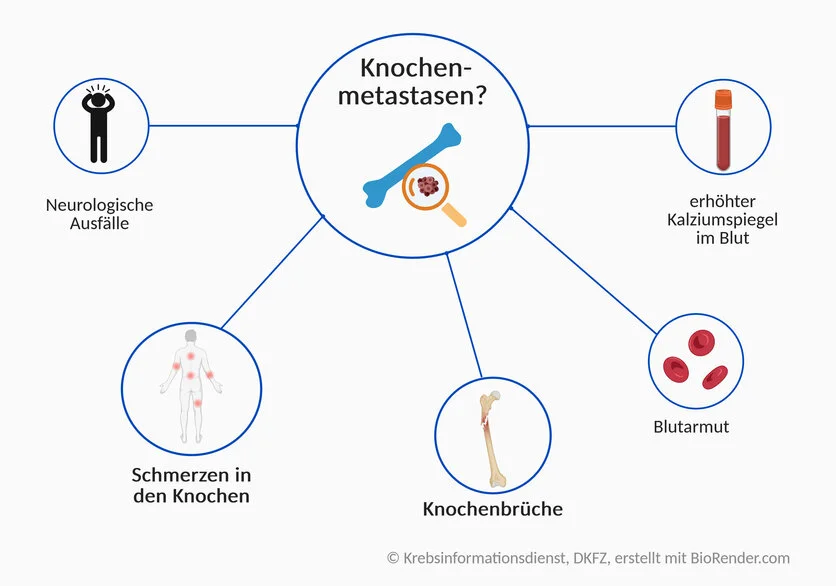 Symptome bei Knochenmetastasen, © Krebsinformationsdienst, DKFZ, erstellt mit BioRender.com Symptome bei Knochenmetastasen: Schmerzen in den Knochen, Knochenbrüche, neurologische Ausfälle; auch Blutarmut oder ein erhöhter Kalziumspiegel können auf Knochenmetastasen hinweisen.