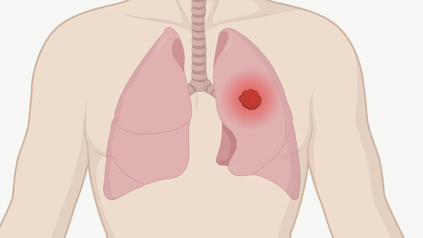Grafik eines menschlichen Oberkörpers mit Lunge und Luftröhre. Ein Tumor in der Lunge ist als leuchtender Punkt dargestellt.