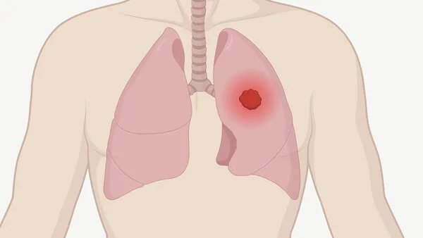 Tumor in der Lunge, © Krebsinformationsdienst, DKFZ; erstellt mit BioRender.com Grafik eines menschlichen Oberkörpers mit Lunge und Luftröhre. Ein Tumor in der Lunge ist als leuchtender Punkt dargestellt.