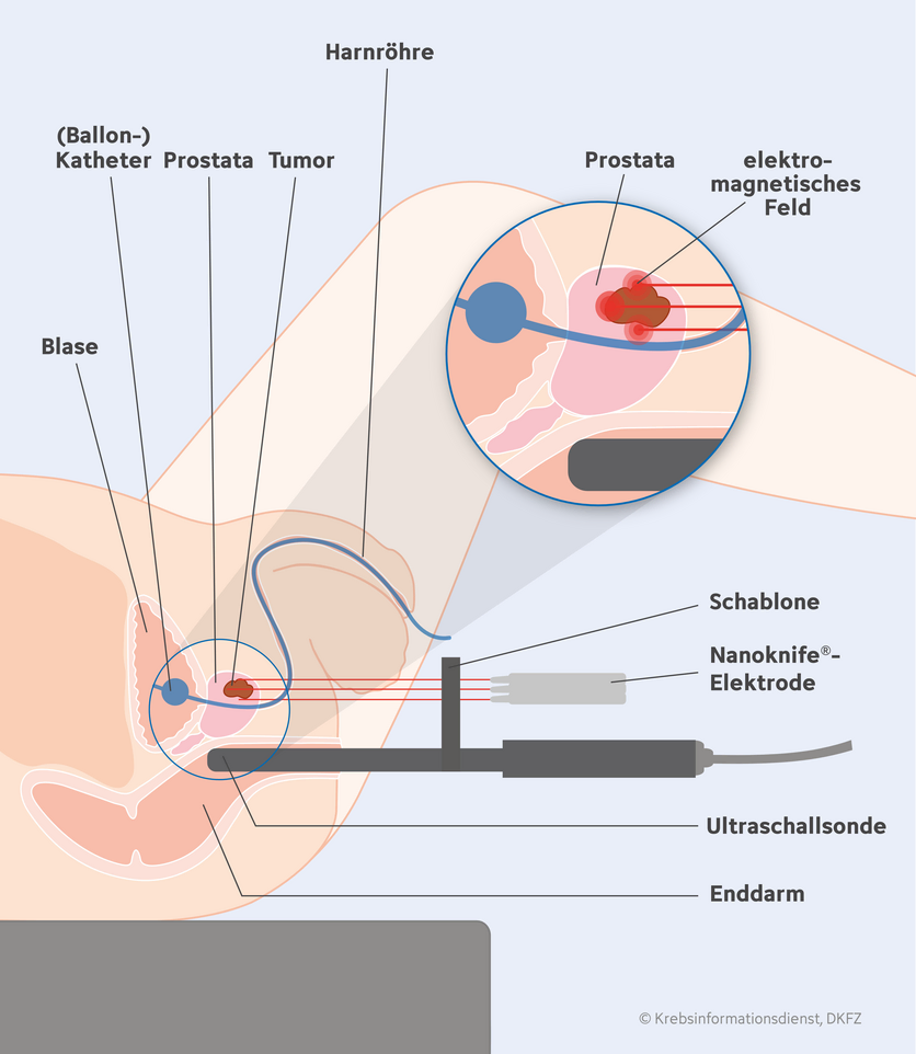 Fokale irreversible Elektroporation bei Prostatakrebs, © Krebsinformationsdienst, DKFZ; erstellt von Anna Diechtierow Grafische Darstellung einer fokalen irreversiblen Elektroporation mit dem Nanoknife® bei Prostatakrebs.