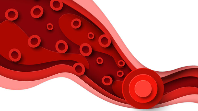 Blutgerinnsel: Thrombus verstopft Blutgefäß