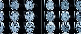 MRT-Bild Hirnmetastasen, links ohne, rechts mit Kontrastmittel © Dean Hoch, Thinkstock