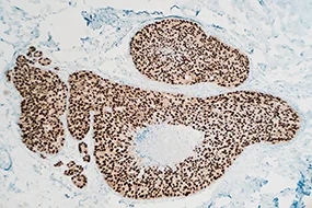 Immunhistochemie Brustkrebs Immunhistochemie Brustkrebs © rightdx - Thinkstock