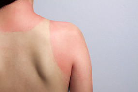 Deutlich sichtbarer Sonnenbrand © asiandelight/Fotolia