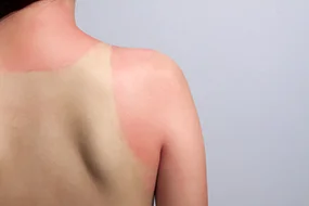 Deutlich sichtbarer Sonnenbrand, asiandelight/Fotolia Deutlich sichtbarer Sonnenbrand © asiandelight/Fotolia