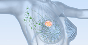 Grafik einer weiblichen Brust mit Tumor Grafik einer weiblichen Brust mit Tumor © Axel Koch - Fotolia.com