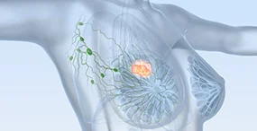 Grafik einer weiblichen Brust mit Tumor Grafik einer weiblichen Brust mit Tumor © Axel Koch - Fotolia.com